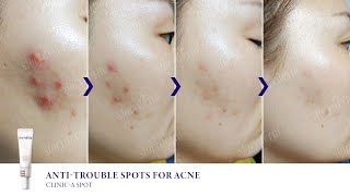 스토리덤  storyderm  ClinicA SpotAntibacterial Acne Skin Use extrusion of suppurative acne [upl. by Odelia435]