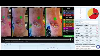 Tissue Analytics venous ulcer chronic wound healing progress [upl. by Evyn]