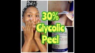 DIY 30 Glycolic Peel  Application  Dark Spot Treatment [upl. by Attikin]