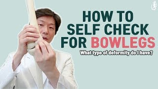 How to SelfCheck for Bowlegs [upl. by Gaynor]