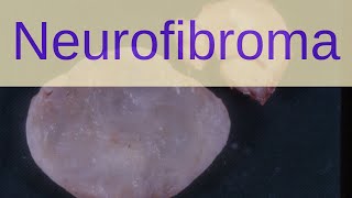 What is a Neurofibroma  Pathology mini tutorials [upl. by Eical]