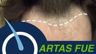 Hair Transplant to restore Receding Hairline [upl. by Niran]