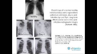 Ask the Expert  Part 6 What is the longterm impact of Legionnaires Disease Legionellosis [upl. by Loveridge]