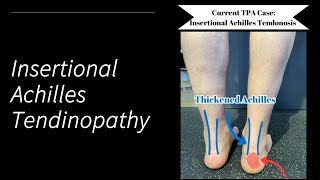 Insertional Achilles Tendinopathy [upl. by Laeahcim]