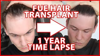 FUE Hair Transplant Timeline 1 YEAR  day 1365  12 Months Progress Before and After [upl. by Shepard]