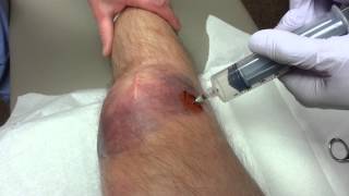 Broken patella blood draining [upl. by Glassman]