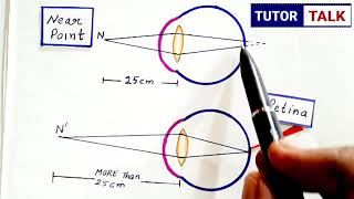 Class 10th  Myopia and Hypermetropia  Human Eye and Colourful World  Defects of Vision [upl. by Bax]