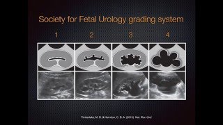 Grading Hydronephrosis on Bedside Ultrasound [upl. by Assetniuq]