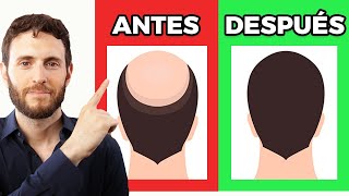 ¿Qué es la Alopecia Areata  TRATAMIENTO Y DIAGNÓSTICO [upl. by Nylkoorb]