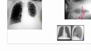 Dressler Syndrome Post Cardiac Injury Syndrome [upl. by Assirralc]