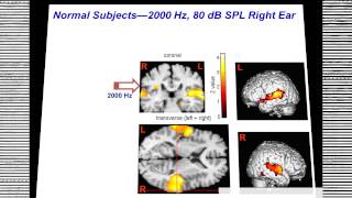 2014 Hyperacusis Research Webinar SUNY [upl. by Homans]