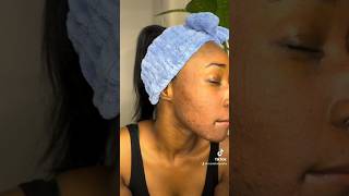 Chemical Peel  Before and After  50 Glycolic Acid Chemical Peel At Home [upl. by Richie]