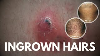 What are Ingrown hairs How to get rid of ingrown hairs [upl. by Schilt]