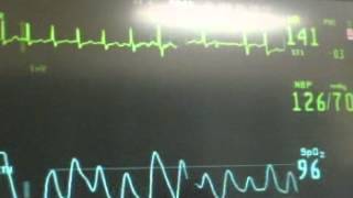 SVT to Sinus Conversion with Adenosine [upl. by Fionnula300]