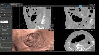 Vitrea Demonstrations  Colon Analysis [upl. by Kilan]