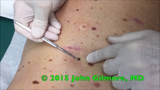 Multiple Dilated Pores  Blackhead Extractor [upl. by Arahset]