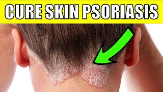 Cure Scalp Psoriasis Permanently With These 7 Natural Remedies [upl. by Amlus]