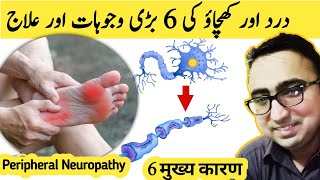 The Real 6 Causes amp Treatment Of Nerve Pain amp Numbness  Peripheral Neuropathy [upl. by Auhsoj]