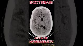 Area of hyperdensity ct brain shortvideo [upl. by Charlot]