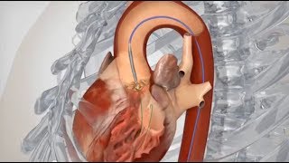 Transfemoral Aortic Valve Replacement Animation [upl. by Ysle]