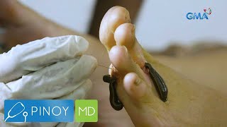 Leech therapy ligtas at epektibo nga ba  Pinoy MD [upl. by Aikrehs]