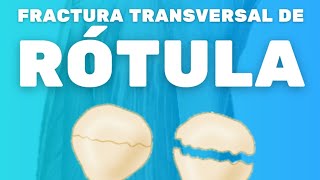 FRACTURA TRANSVERSAL DE RÓTULA [upl. by Bolger]