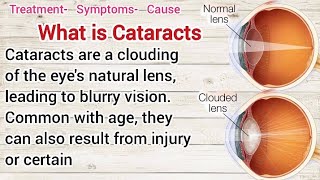 What is cataractsTreatmentSymptoms amp Causes [upl. by Nomaid]