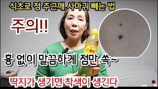 주의식초로점빼기점 기미 주근깨 쥐젖 비립종 사마귀딱지 없이 점만 쏙 [upl. by Claudia423]