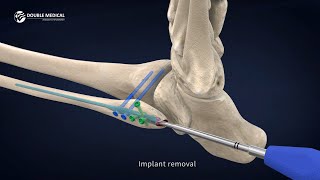 Fibular Nail Surgical Technique  StepbyStep Animation Guide  Fibular Nail Indications amp features [upl. by Roxana166]