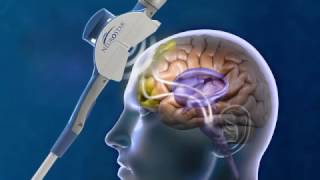 How Does Transcranial Magnetic Stimulation work [upl. by Froehlich92]