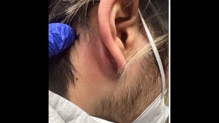 Mastoiditis vs Posterior Auricular Abscess andor Epidermoid Cyst [upl. by Nils248]