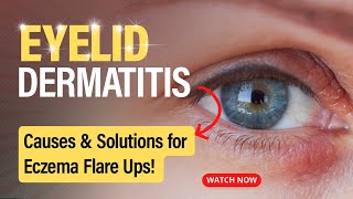 Eyelid Dermatitis Uncovered Causes and Solutions [upl. by Esil]