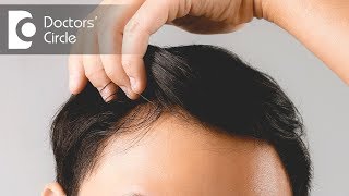 Can mildly elevated platelet count lead to hair loss  Dr Rasya Dixit [upl. by Kalina828]