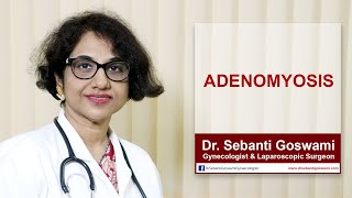 Adenomyosis Symptoms Causes and Treatment  What is Adenomyosis [upl. by Herrah222]