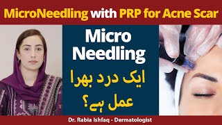 Microneedling With PRP For Acne Scars  Is It Painful Procedure  Microneedling Kya Hota Hai [upl. by Belinda]