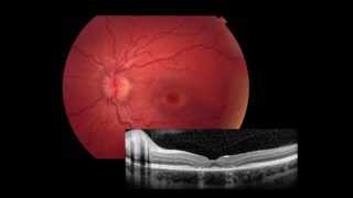 Retina Imaging amp ERG [upl. by Heymann]