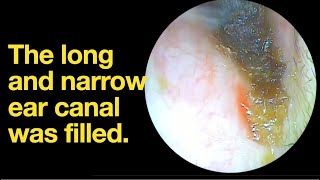 The long and narrow ear canal was filledear wax removal  ear cleaning  ASMR  relaxation  relax [upl. by Pascha988]