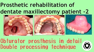 Prosthetic rehabilitation of dentate maxillectomy patient  Part 2 [upl. by Geraint608]