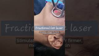 CO2 fractional laser✨ co2laser skintreatment skincare shortsfeed [upl. by Ahtilat]