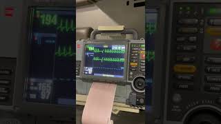 Heart anatomy heartattack heartbeat bradycardia 3danimation [upl. by Mohammad]