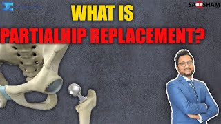 What is Partial Hip Replacement DrdebashishChanda [upl. by Norvan]