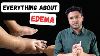 Edema  Oedema  Pathology  Differential Diagnosis  Swelling  Lymphadenopathy  Saad Khan [upl. by Rdnaskela]