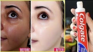 HOW TO WHITEN YOUR FACIAL SKIN OVERNIGHT STRONG MASK FACE MASK AT HOME [upl. by Aicenra283]