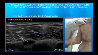 Subscapularis Recess Bicipital Sheath Distension and Partial Supraspinatus Tear [upl. by Sallie]