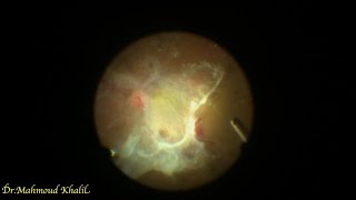 Unimanual vitrectomy in tractional retinal detachment [upl. by Dorothea237]