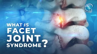 What is Facet Joint Syndrome [upl. by Tamqrah]