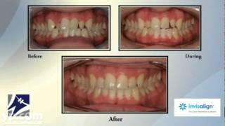 Wood Orthodontics  Braces  Invisalign  Anthem AZ [upl. by Lovato]