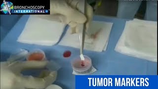 Tumor Markers and EBUS [upl. by Brant]