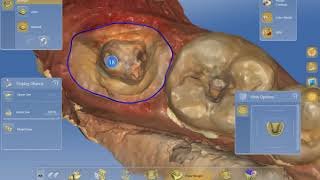 Designing EndoCrown By Cerec [upl. by Serrano]