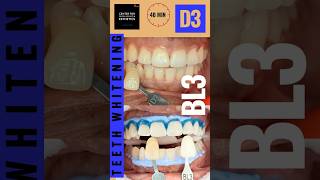 Teeth Whitening In Office 40 min teethwhitening teethcleaning teethwhitener opalescenceboost [upl. by Jahdiel]